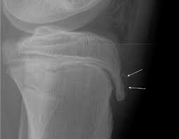 osgood-schlatter