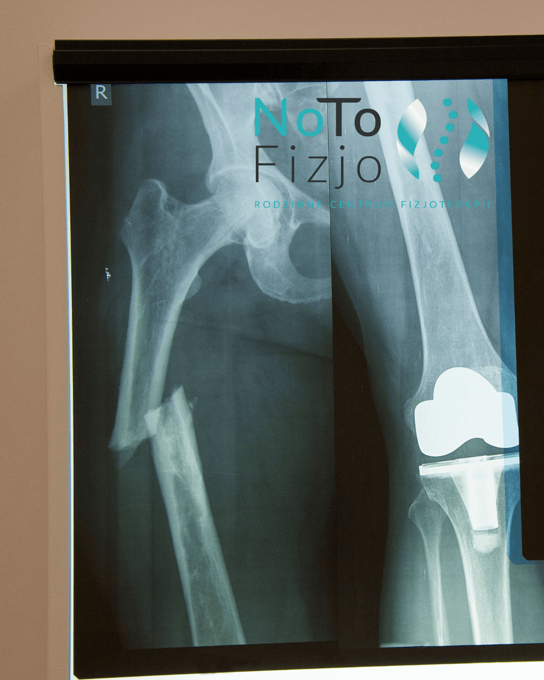 You are currently viewing Rehabilitacja po złamaniu kości udowej – Fizjoterapia BYTOM