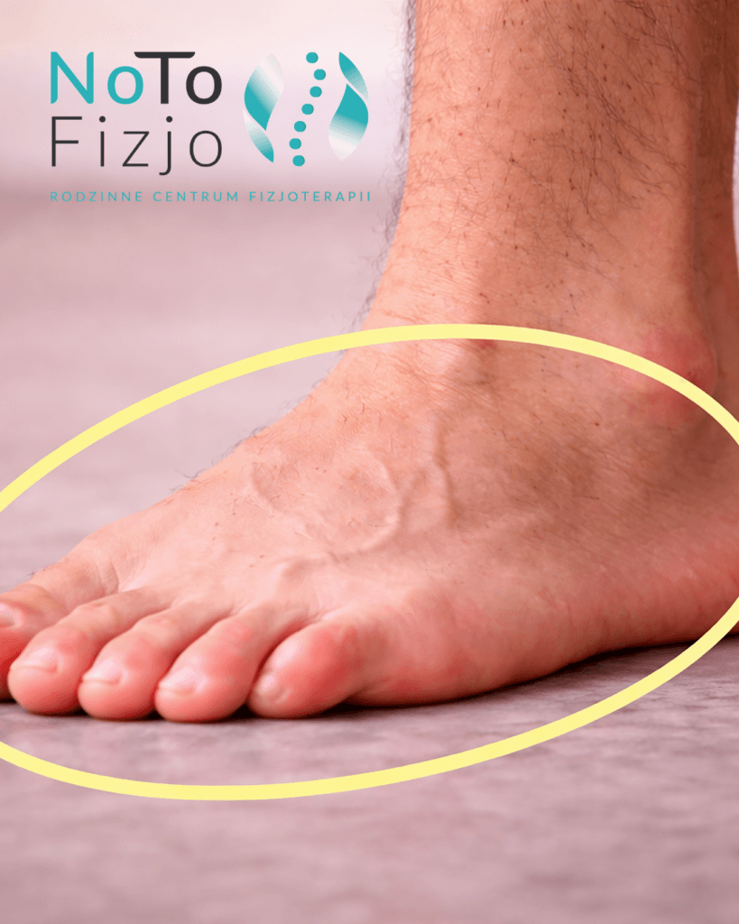 Złamanie V kości śródstopia