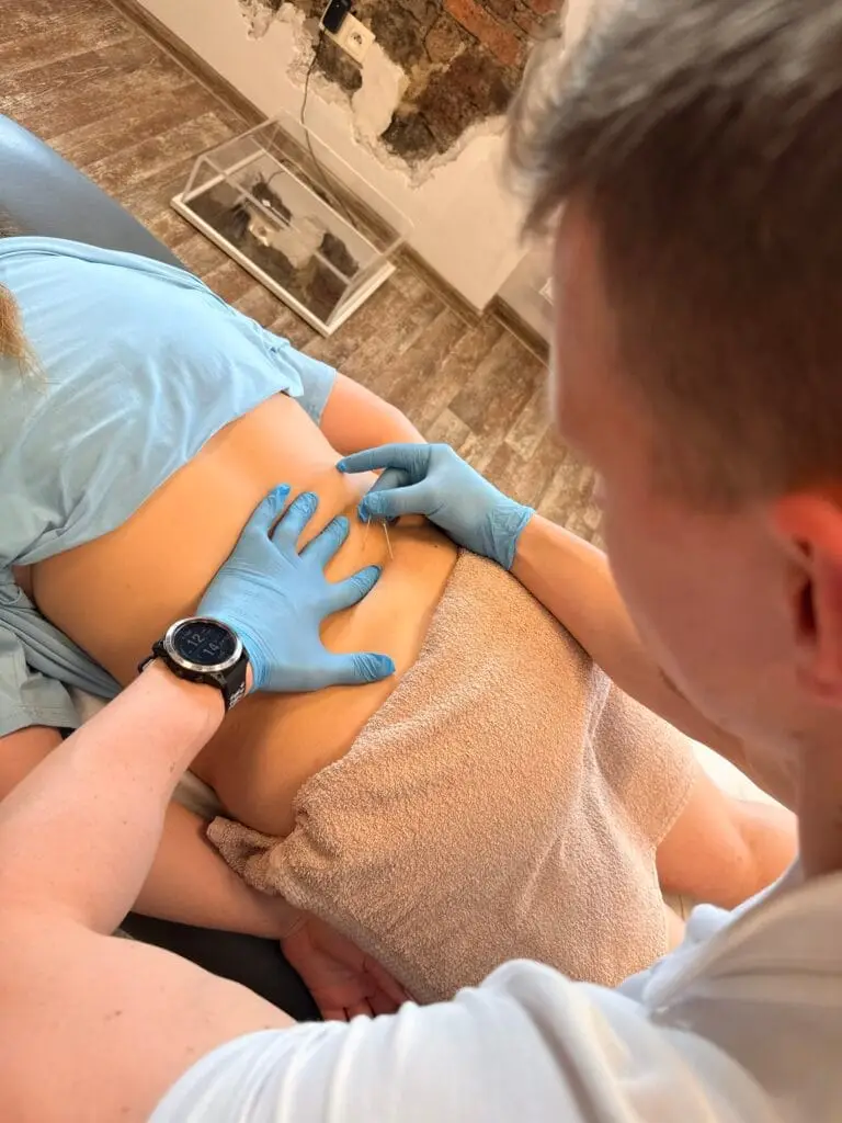 dry-needling-igloterapia-sucha-zabieg-fizjoterapeuty
