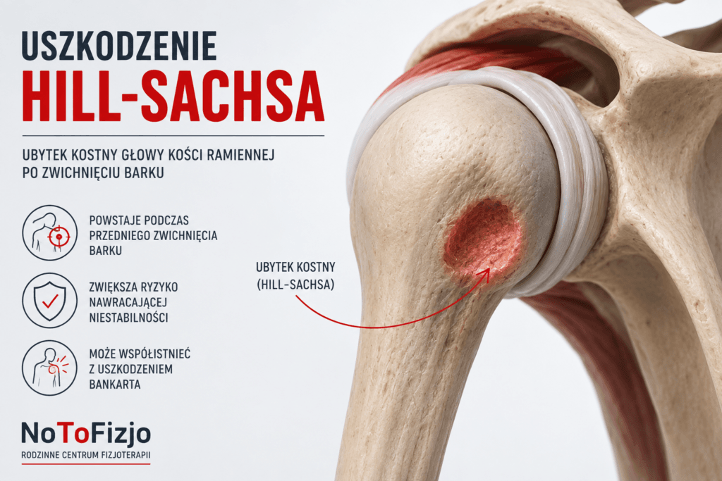 Uszkodzenie Hill-Sachsa barku – objawy, diagnostyka, leczenie i rehabilitacja po zwichnięciu barku.