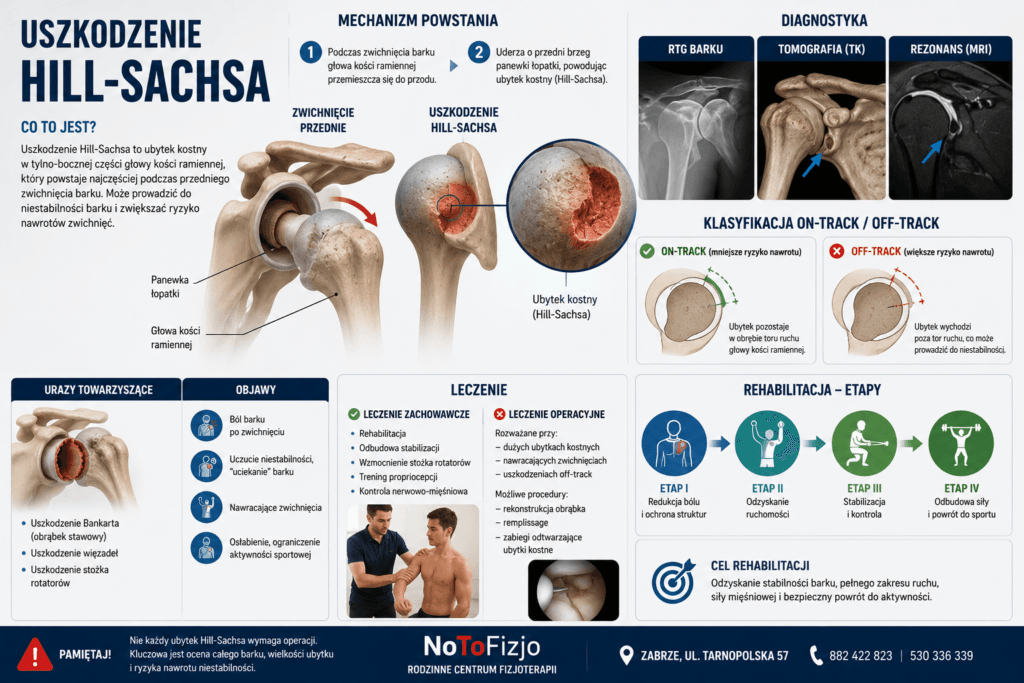 Uszkodzenie Hill-Sachsa barku – objawy, diagnostyka, leczenie i rehabilitacja po zwichnięciu barku.