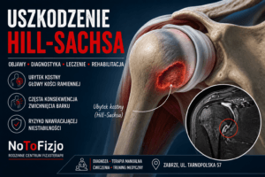 Read more about the article Uszkodzenie Hill-Sachsa – objawy, leczenie i rehabilitacja | Fizjoterapeuta Gliwice