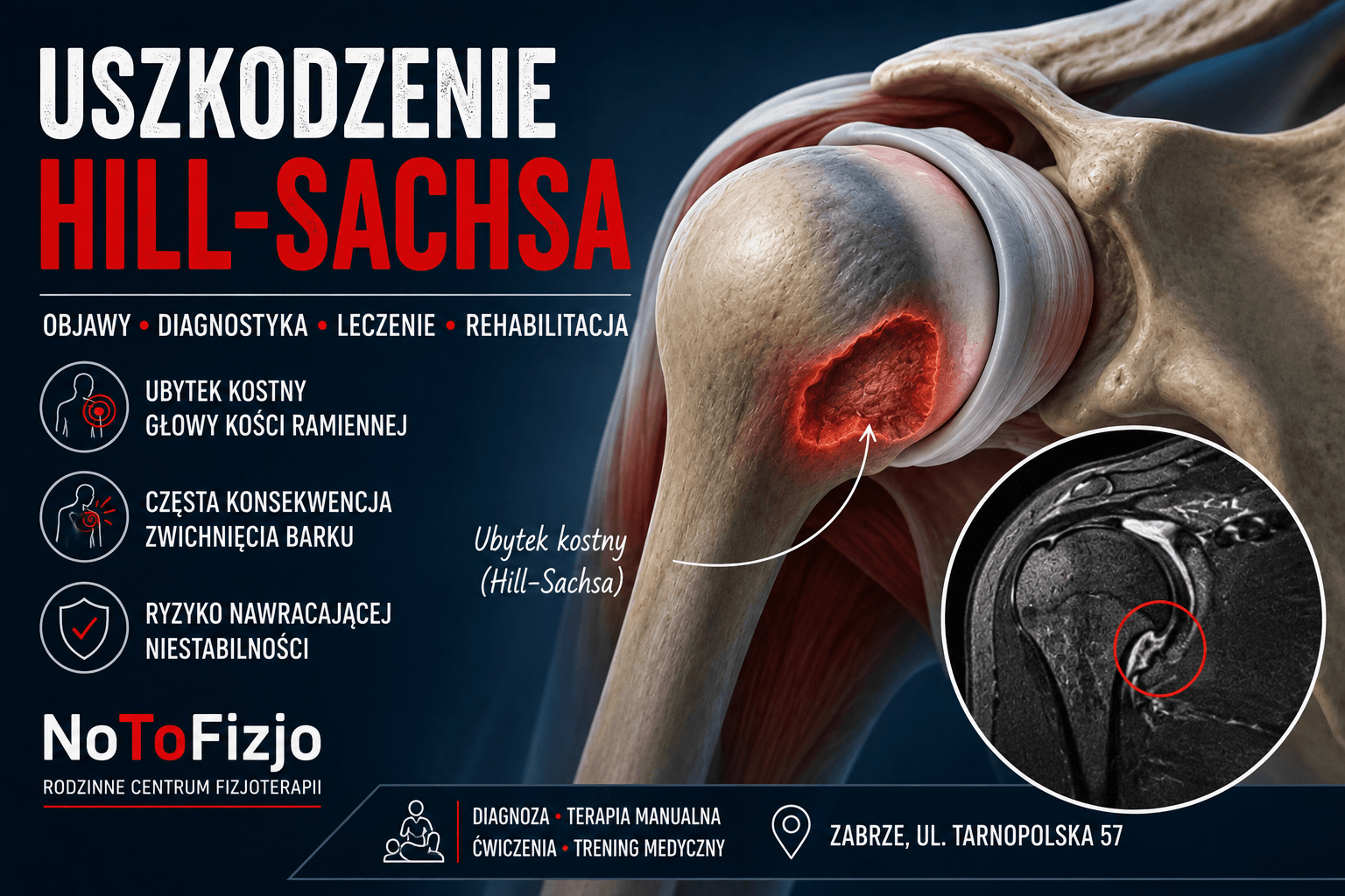 You are currently viewing Uszkodzenie Hill-Sachsa – objawy, leczenie i rehabilitacja | Fizjoterapeuta Gliwice