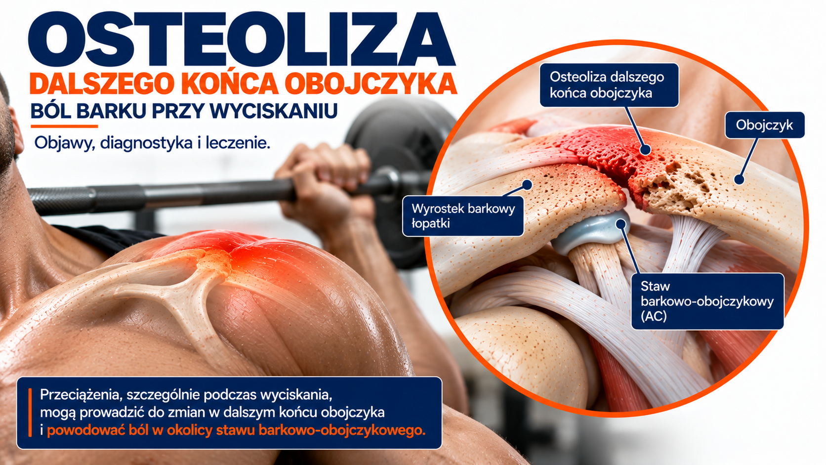 You are currently viewing Osteoliza obojczyka – ból barku przy wyciskaniu | FIZJOTERAPA GLIWICE