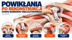 Read more about the article Powikłania po rekonstrukcji stawu barkowo-obojczykowego – objawy, przyczyny i dalsze leczenie