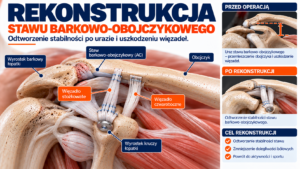 Read more about the article Rekonstrukcja stawu barkowo-obojczykowego – operacja i rehabilitacja BYTOM