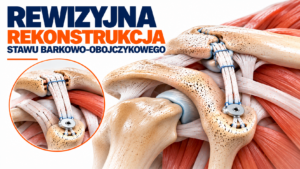 Read more about the article Rewizyjna rekonstrukcja stawu AC – leczenie | NoToFizjo